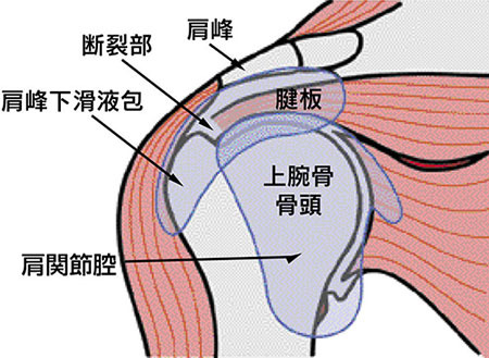 肩腱板断裂 その2月 原因と病態_a0296269_09110575.jpg