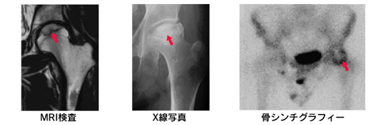 大腿骨頭壊死症 その3 診断_a0296269_09044543.gif