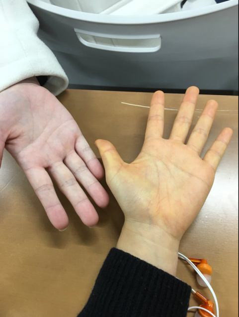 黄疸 暮らしのおともに 黄疸 暮らしのおともに