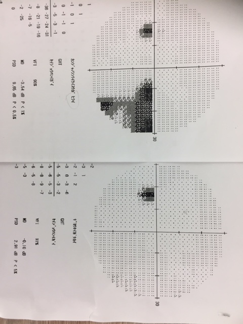 緑内障は治る、治癒率は？　_b0200019_23535662.jpg