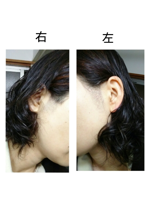 もみあげ 脱毛 女 医療 Tine Life 私の日々って何だろ もみあげ 脱毛 女 医療 Tine Life 私の日々って何だろ