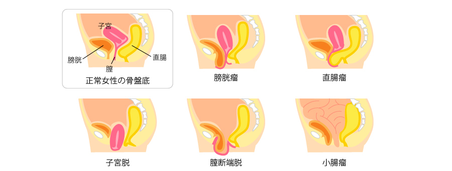 骨盤底筋群の不具合をなんとかする・・・_f0135940_13522396.jpg