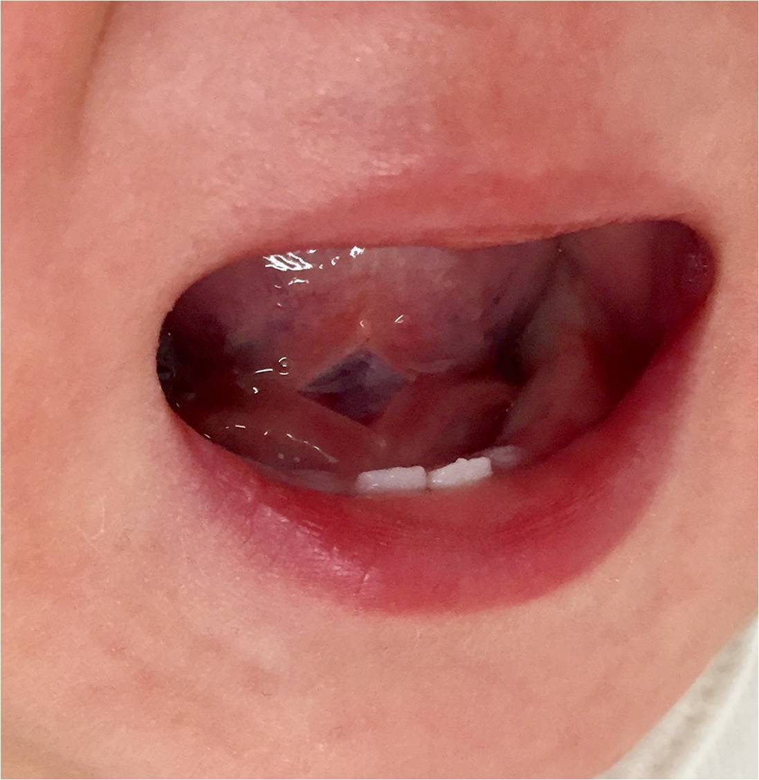 舌小帯短縮症に対する私の診断基準と手術方針 お子さんの舌小帯短縮症でお悩みの方へ