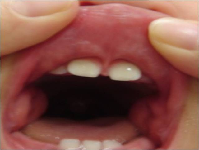 上唇小帯短縮を合併している舌小帯短縮症に対する私の治療方針 お子さんの舌小帯短縮症でお悩みの方へ
