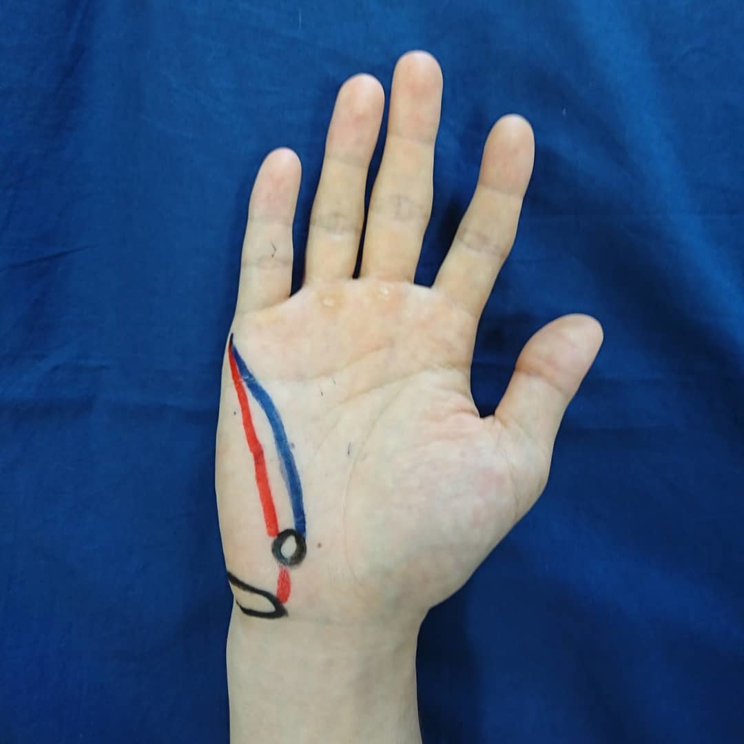 第158回TOC体表解剖勉強会｜小指外転筋、短小指屈筋、小指対立筋_b0329026_12333504.jpg