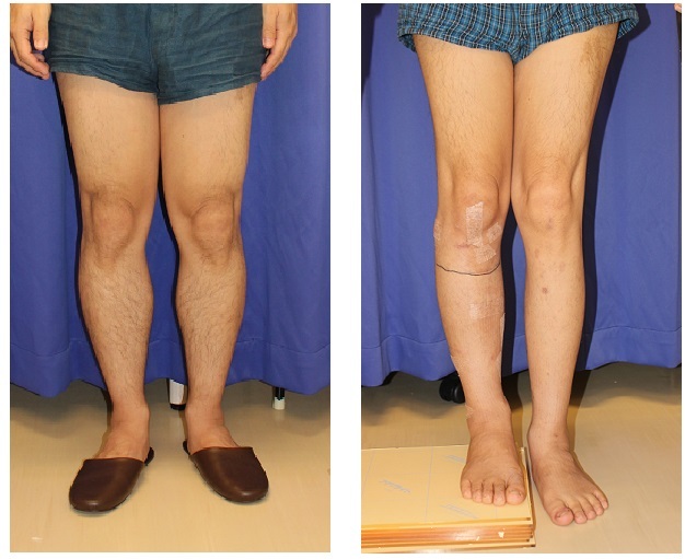 脚延長　：　　左下肢ISKD　術後約１年　５ｃｍ延長　　　，　　右下肢　precice　術後約３週間_d0092965_03110014.jpg