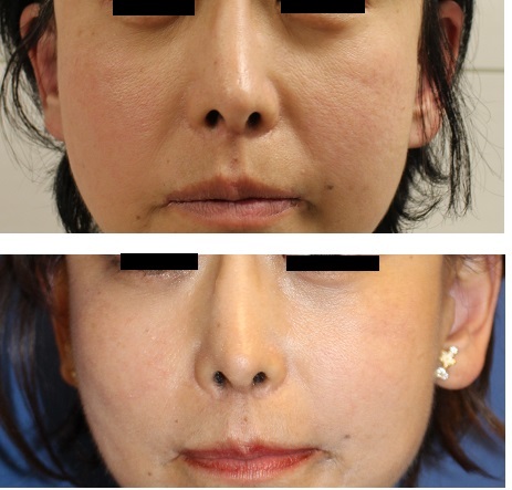 顔面若返りFAMI法(fat autograft muscular injection ) + 法令線 PDRN(Polydeoxyribonucleotide)注射(サーモン注射)_d0092965_06310908.jpg