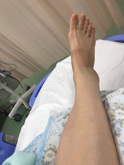 足骨折しました。_a0050302_13211296.jpg