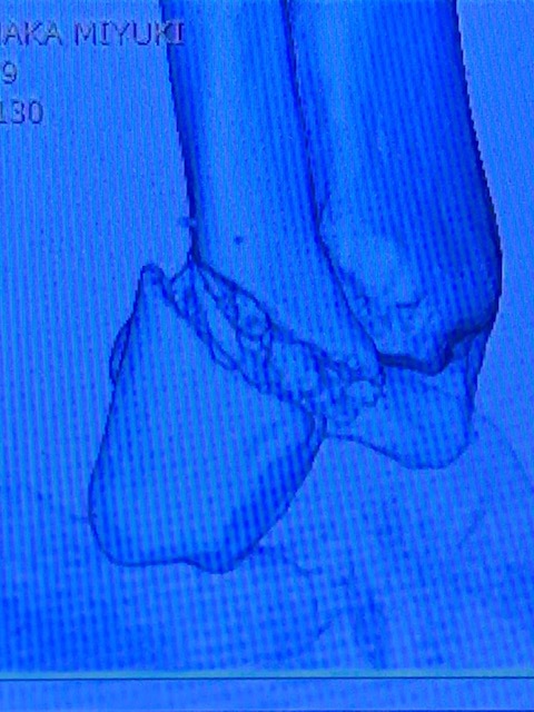 足骨折しました。_a0050302_13251449.jpg