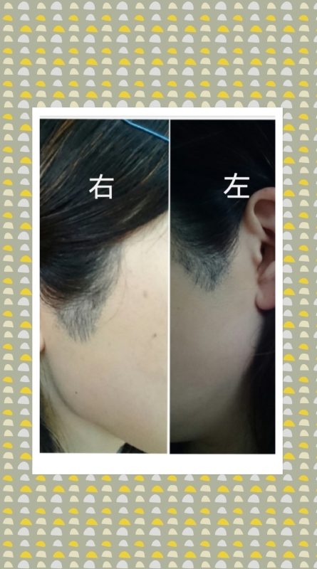もみあげ 脱毛 女 ファイナル Tine Life 私の日々って何だろ もみあげ 脱毛 女 ファイナル Tine Life 私の日々って何だろ