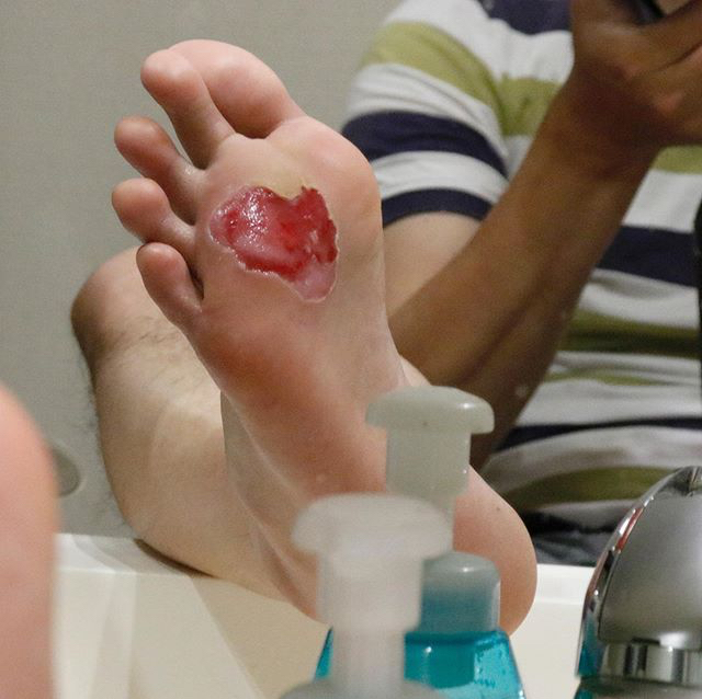 【閲覧注意】100km歩いた後の足の裏_c0060143_03295540.jpg