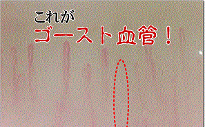 末梢動脈閉塞症_e0097212_15483730.gif