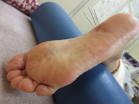 足の裏が痛む40代女性 足底筋膜炎の治療 日進市のトライ鍼灸接骨院ブログ
