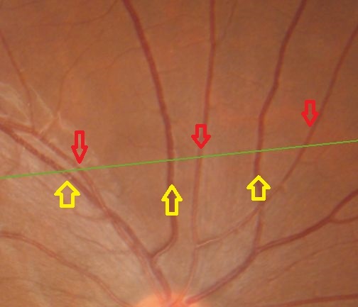 網膜の血管（？）が見える_e0137559_09213519.jpg