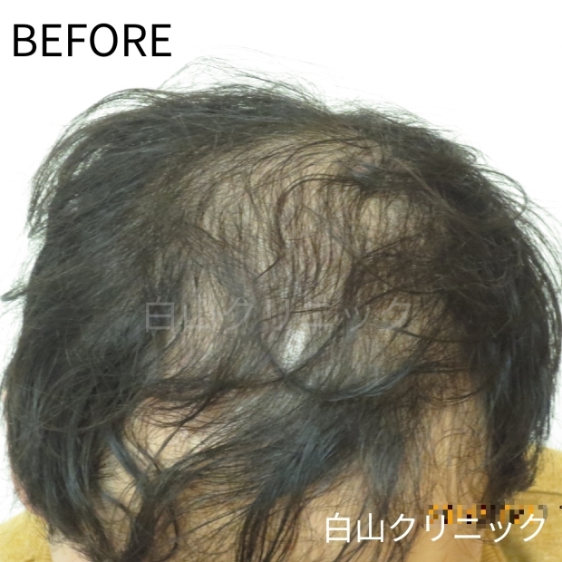 AGA(男性型脱毛症)治療　_a0206544_11073946.jpg