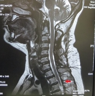 後縦靭帯骨化症 MRI 2015 2018 比較画像 osl-nara_a0383927_15585841.jpg