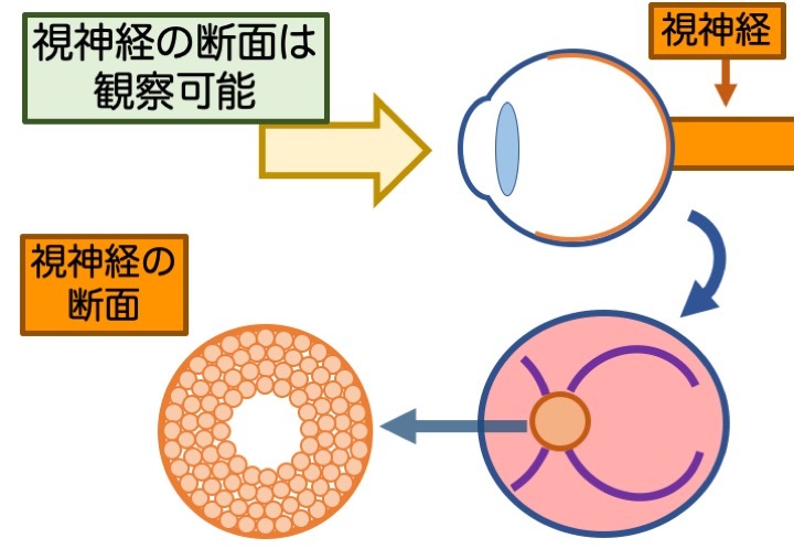 緑内障の誤解 その3「眼圧が高いと緑内障」 part 2_a0257968_16452842.jpeg