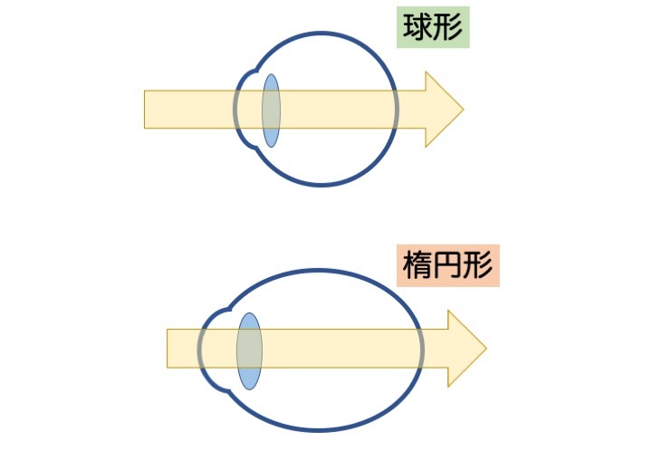 緑内障の誤解 その3「眼圧が高いと緑内障」 part 2_a0257968_16561984.jpeg