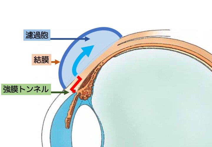 緑内障の誤解 その4「手術で治療できる」 part 6_a0257968_09345578.jpeg