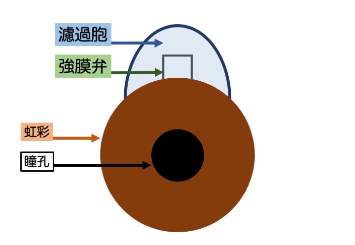 緑内障の誤解 その4「手術で治療できる」 part 6_a0257968_09353630.jpeg