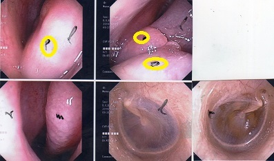鼻で息が出来ない 苦しい 白血球数にこだわっています 鼻で息が出来ない 苦しい 白血球数にこだわっています
