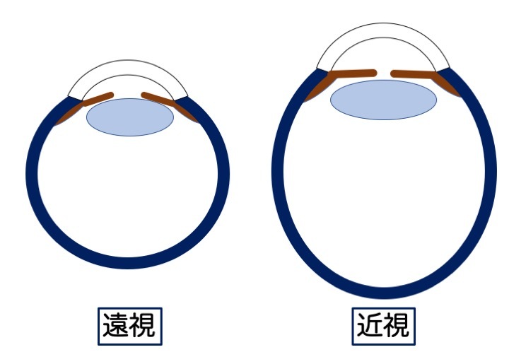 緑内障の誤解 その5「誤解の根源」 part 3_a0257968_15004509.jpeg