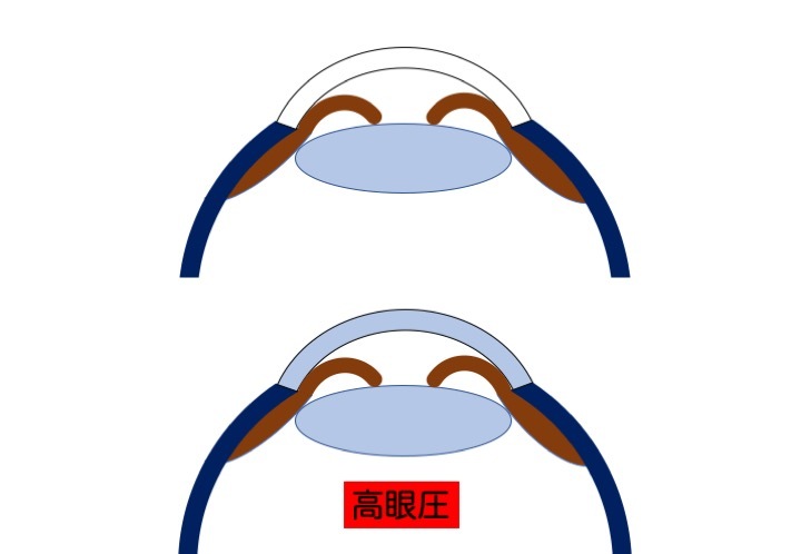 緑内障の誤解 その5「誤解の根源」 part 3_a0257968_16063211.jpeg