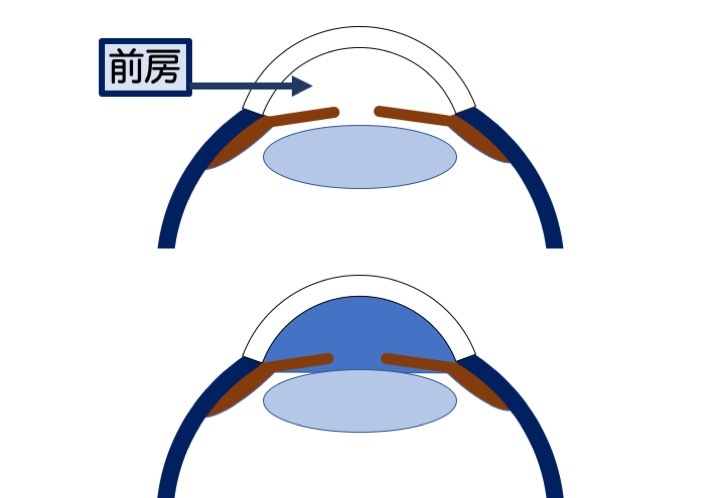 緑内障の誤解 最終章「生涯、点眼を継続」 part 1_a0257968_13074316.jpeg