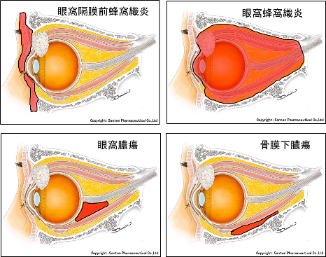 眼瞼腫脹：眼科医が見ているものシリーズ　その９ (1198)_f0088231_22095803.png