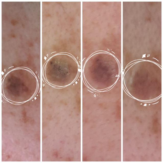 顔のシミが 菟紗萓堂