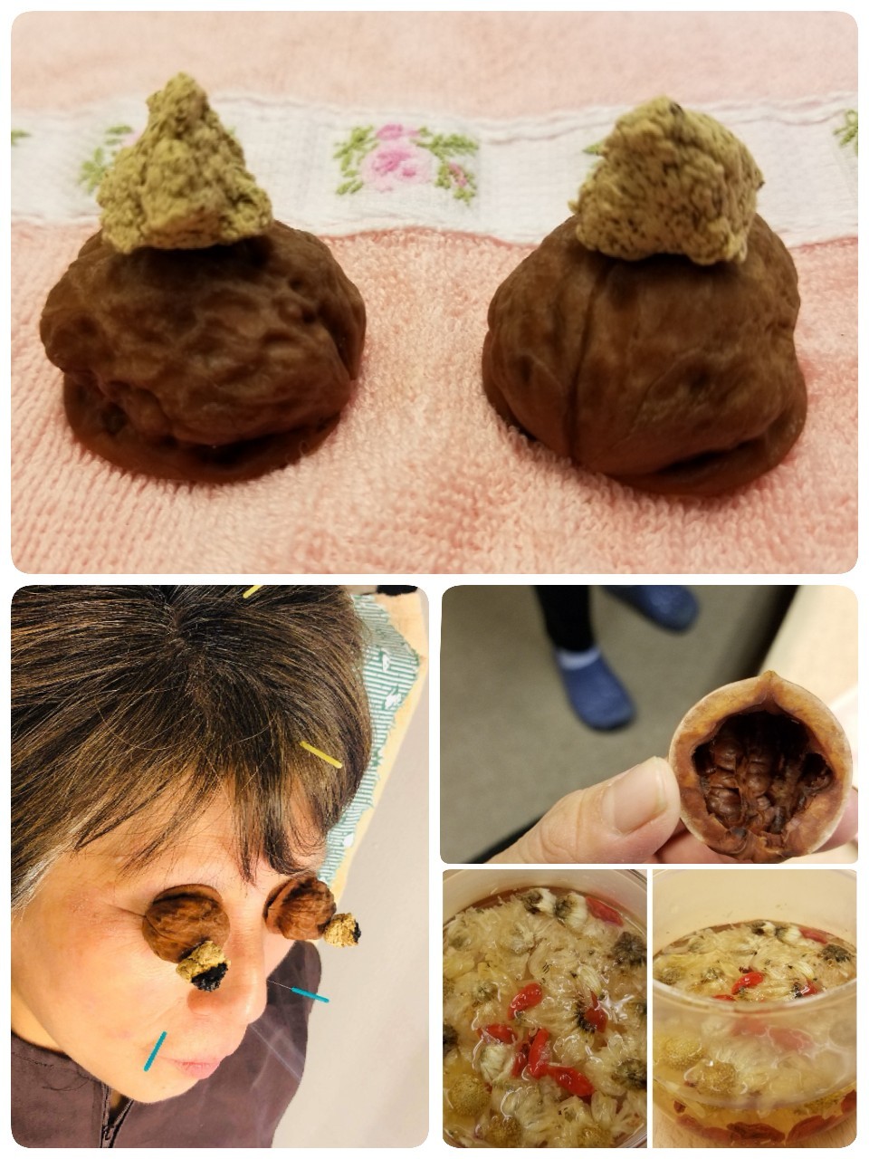 初 くるみ灸 冷蔵庫は我が家のくすり箱 ー薬膳塾 美暮びと ー 初 くるみ灸 冷蔵庫は我が家のくすり箱 ー薬膳塾 美暮びと ー