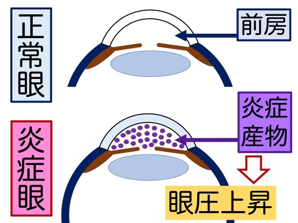 第9章 数多の見解 「生涯 “点眼” 継続」 _a0257968_14553209.jpeg