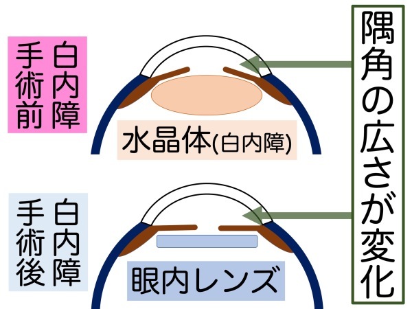 第8章　最大の誤解「緑内障禁忌」_a0257968_15122001.jpeg