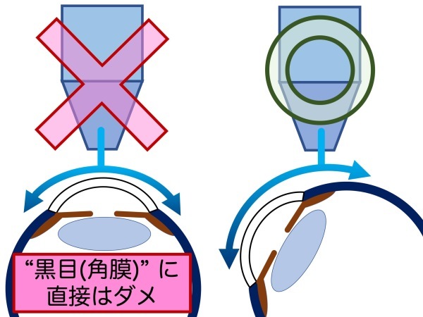 第6章　実践その３　点眼できてますか？_a0257968_15450993.jpeg