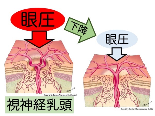 第5章 実践その2 緑内障の治療_a0257968_15500311.jpeg
