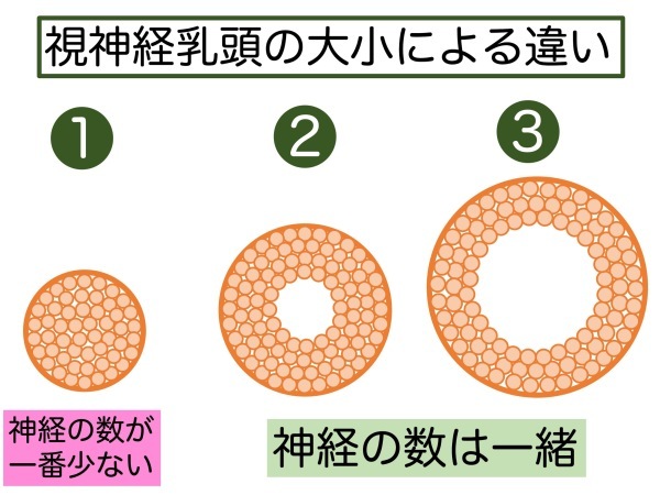 第4章 実践その1 緑内障の見つけ方_a0257968_15590933.jpeg