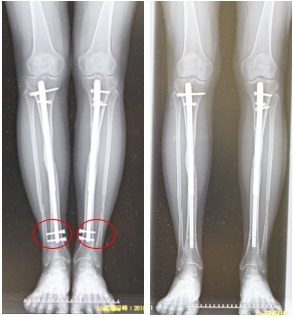 ISKD 下腿　約８ｃｍ　脚延長後　遠位横止めスクリュー抜去術　術後半年_d0092965_01535759.jpg