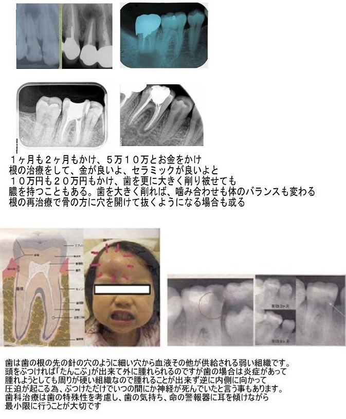 歯は抜かない、神経も取らない、被せない_d0338857_05285152.jpg