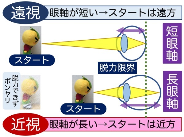 第1章 その3 眼軸と遠視と近視と_a0257968_14013620.jpeg