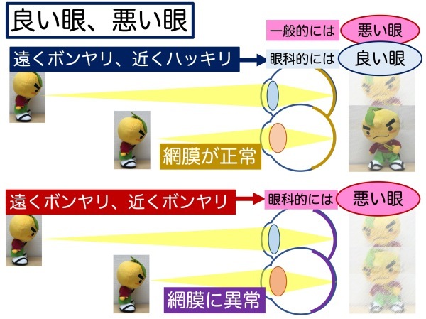 第4章 その4 弱視とは_a0257968_14321507.jpeg