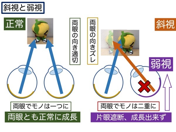 第4章 その4 弱視とは_a0257968_14333096.jpeg