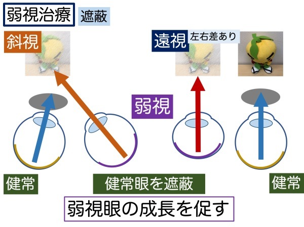 第4章 その4 弱視とは_a0257968_14345268.jpeg