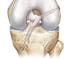 大腿四頭筋腱(Quadriceps Tendon)を移植片に用いたACL再建術後マネジメントについて、アスレティックトレーナーが知っておくべきこと。_b0112009_09590065.png