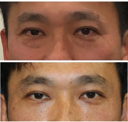 同級生の目の下のくま改善治療 (眼窩脂肪摘出術+下瞼脂肪移植術)_d0092965_02303928.jpg