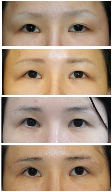 左眼:挙筋短縮術 術後約10年 , 両眉下切開 術後半年再診時_d0092965_05375655.jpg