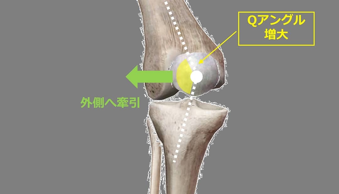 Knee-in&Toe-out(KITO)により生じる膝関節へのメカニカルストレスとスポーツ外傷・障害_b0329026_22393142.jpg