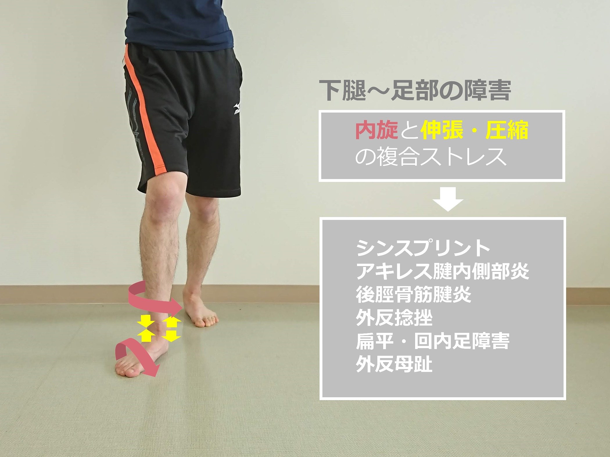 Knee-in&Toe-out(KITO)により生じる下腿から足部へのメカニカルストレスとスポーツ外傷・障害_b0329026_22393188.jpg