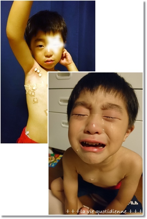 【水いぼ処置】もっと早く行けば良かった…と保育園暗黙の?ルール??再び愛の不時着!_a0348473_01371209.jpg