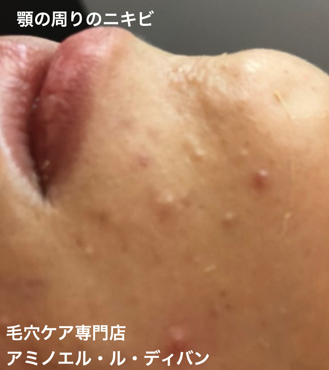 出口のない 白ニキビ 熊本エステ 東京 あなたの綺麗をプロデュース サロン スクール経営 渡邊明美