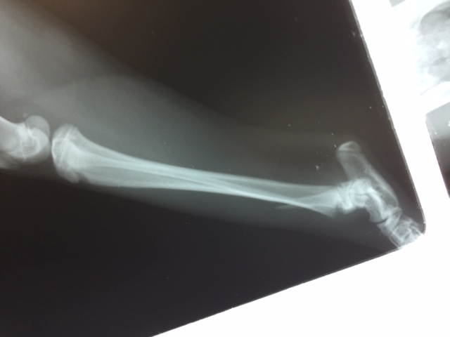 骨折の整復手術　脛骨遠位成長板骨折・腓骨骨折_b0350282_22160469.jpg
